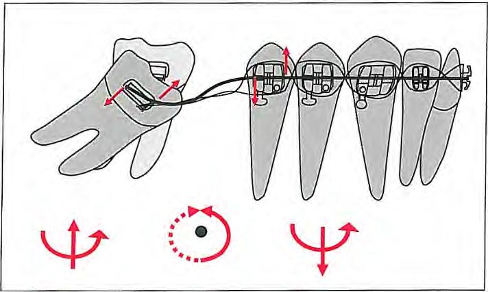 (b) To obtain intrusive force on the molar, the anterior angle (x) needs to be increased. The anterior segment should be incorporated with a full-size SS wire to reinforce anterior anchorage.