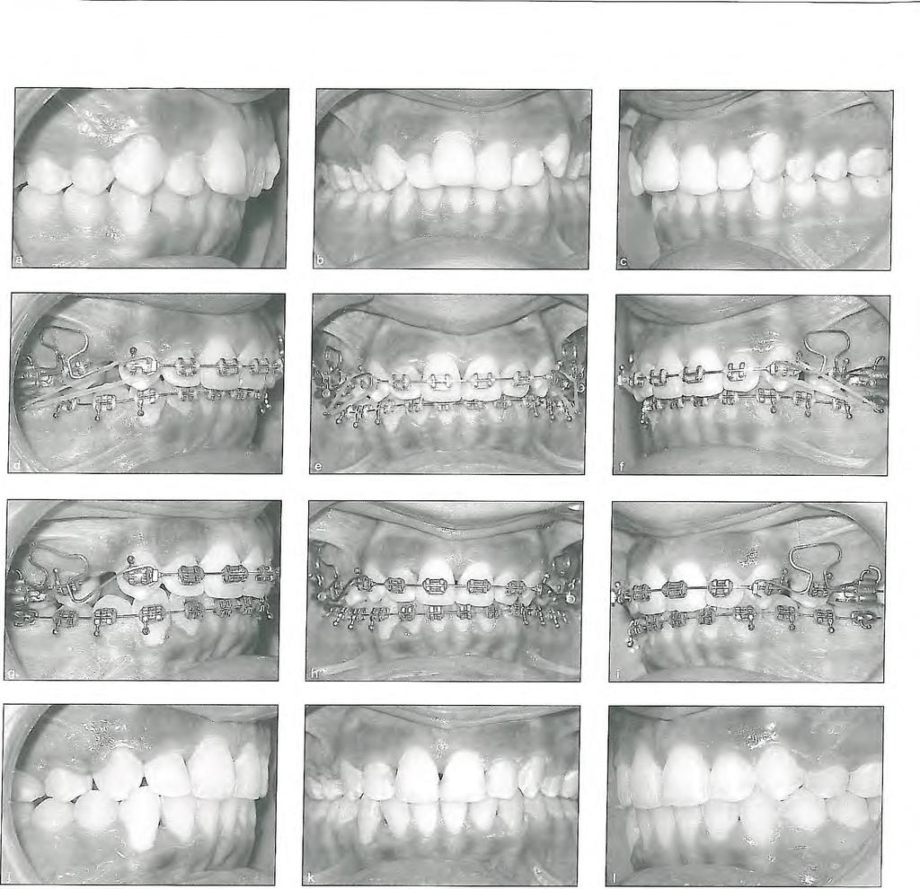 9 I Space Closure 4-1 - ' '.. Fig 9-9 Example of en masse space closure with segmented arch mechanics using 0.016 x 0.022 inch TMA T-loops and Class II elastics. (a to c) Before treatment.