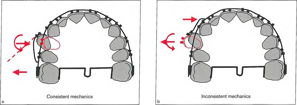 2 I Application of Orthodontic Force Fig 2-19 Examples of consistent and inconsistent mechanics.