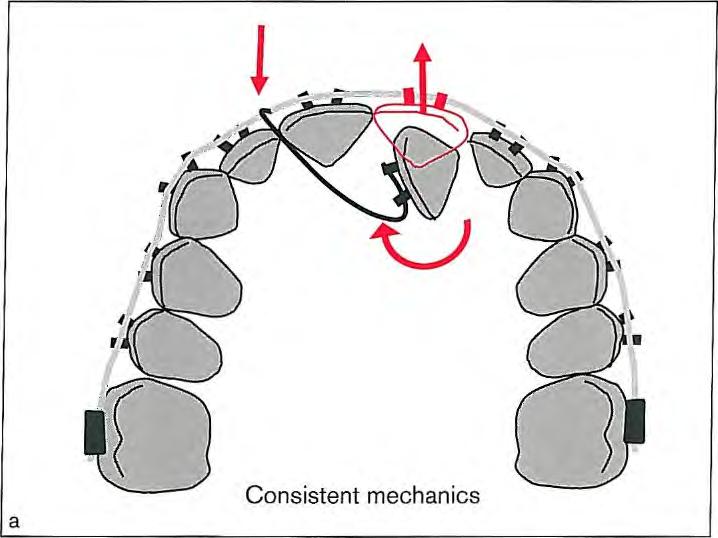 Changing the direction of the cantilever on the same premolar alters the mechanics. The premolar rotates but tips buccally as a reaction to palatally directed force in the canine area (b).