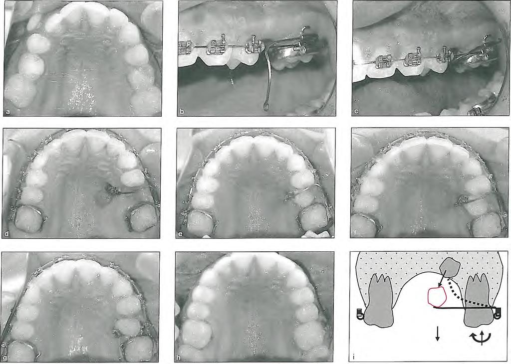 Force Elements Used in Orthodontic Appliances Fig 2-21 (a to i) Using cantilever mechanics to bring an impacted premolar toward the dental arch.