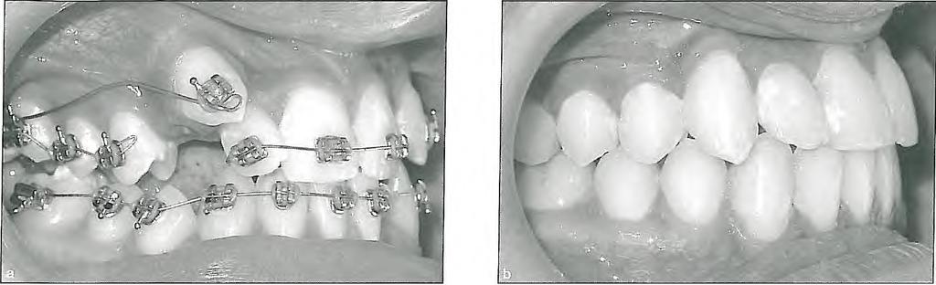 2 I Application of Orthodontic Force Figs 2-22a and 2-22b Cantilever mechanic used to bring a high canine to the arch. Note that the tip of the cantilever wire (0.016 x 0.