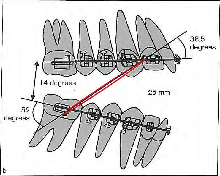 2 I Application of Orthodontic Force Fig 2-29 (a) In a closed mouth, the angle between the Class II elastics and the occlusal plane is approximately 20 degrees.