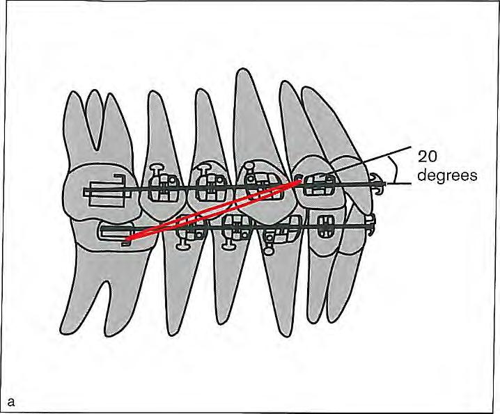 (b) In a mouth opening of 25 mm, the angle between the elastic and the mandibular occlusal plane reaches 52 degrees. (Reprinted from Langlade 56 with permission.