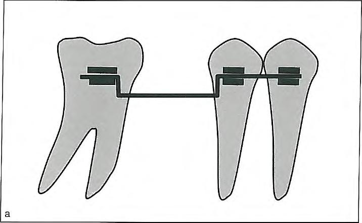 Fig 2-35 Use of Class II elastics in the late transitional dentition after the primary second molars have exfoliated may cause the permanent molars to tip forward and reduce the space available for