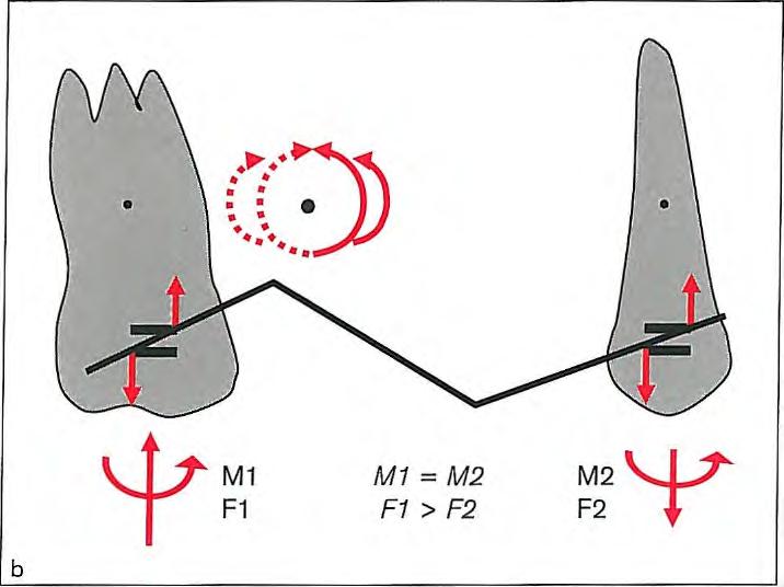 Stepped-Arch Mechanics Fig 3-11 (a) When a stepped arch is placed in the brackets of two teeth with equal anchorage values, equal and same-directional moments occur on both sides.
