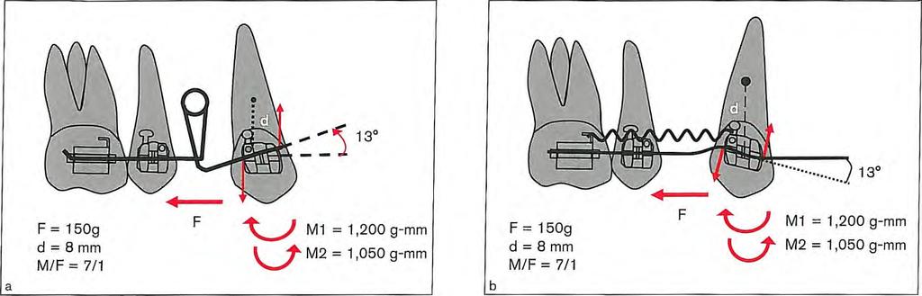 3 I Analysis of Two-Tooth Mechanics Fig 3-17 (a) In standard edgewise mechanics, an antitip bend (second-order bend of 13 degrees) must be placed to move the canine with a controlled tipping movement