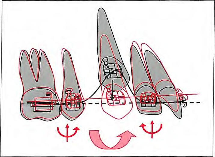 Straight-Wire Mechanics Fig 3-19 Elastic archwire inserted into a high canine bracket deforms the general arch form and sometimes causes canting of the occlusal plane.