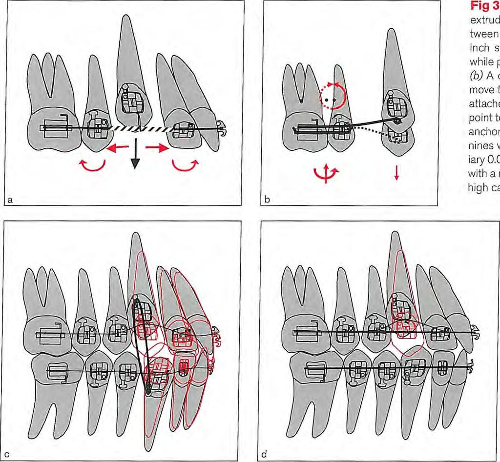 3 I Analysis of Two-Tooth Mechanics Fig 3-20 Four examples of mechanics used to extrude a canine. (a) An open coil spring between the lateral incisor and premolar on 0.