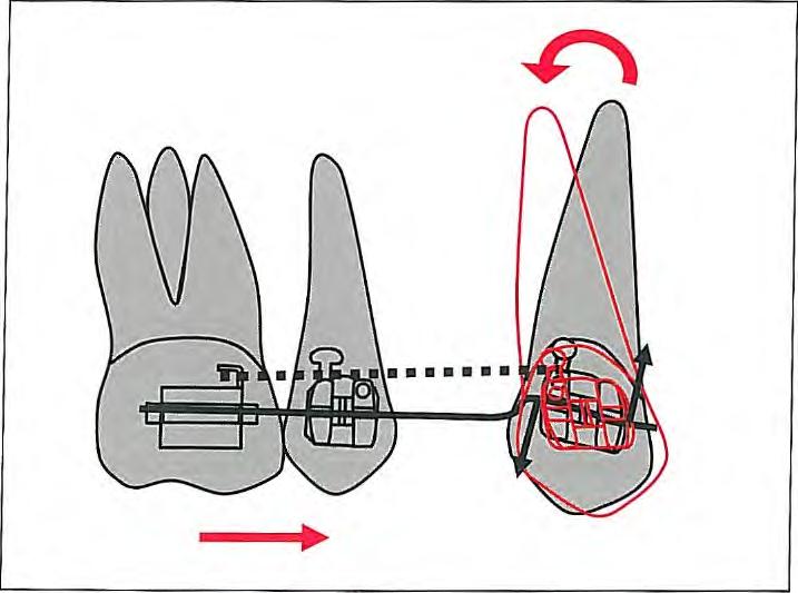 The cantilever should be attached to the canine with a ligature at only one point to avoid unwanted moment (c) Reciprocal anchorage to level maxillary and mandibular canines with an up-and-down