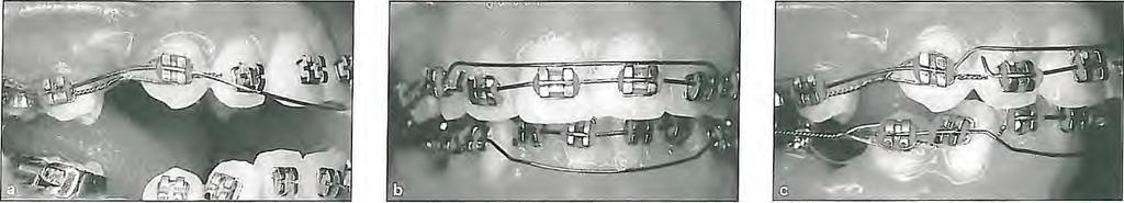 Conclusion Fig 3-22 (a) To avoid extrusion, if a straight wire passing through a vertically positioned canine bracket passes below the incisors, one should not place the wire in the incisor brackets.