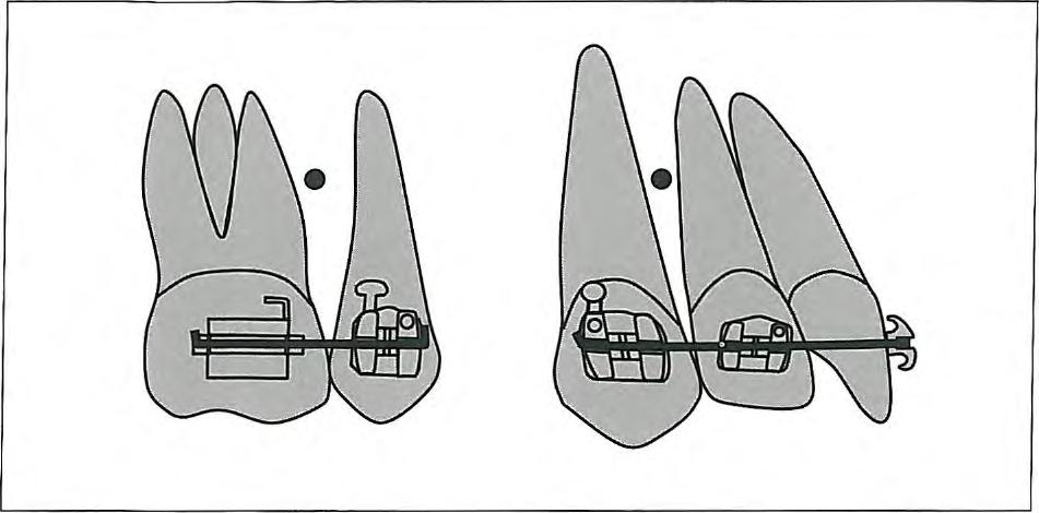 4 I Frictional and Frictionless Systems Fig 4-8 In the segmented arch technique, anterior and posterior teeth are incorporated into two segments with rectangular wires.