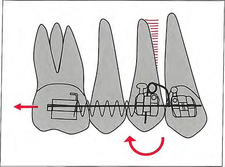 5 I Anchorage Control Fig 5-1 Anchorage values of various teeth.' (Redrawn from Proffit' with permission.