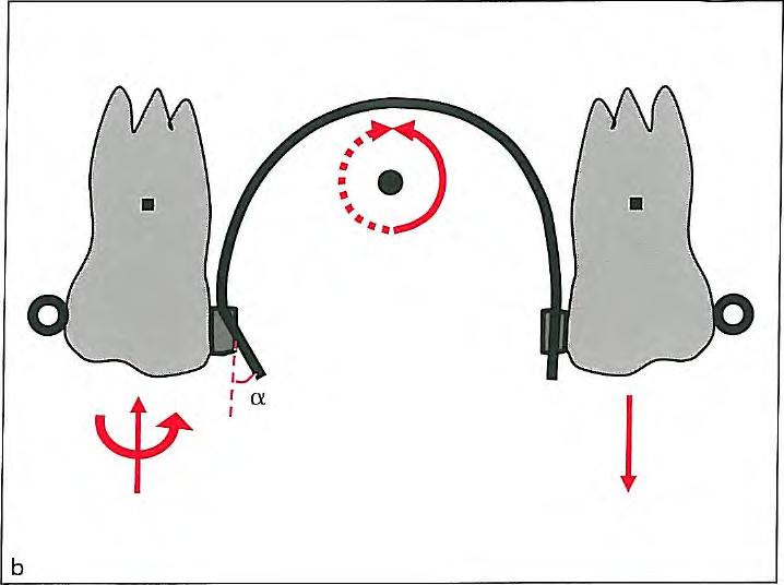 Intraoral Methods Fig 5-3 Cortical bone anchorage prevents the molars from moving mesially. A transpalatal arch moves the roots by reciprocal anchorage.