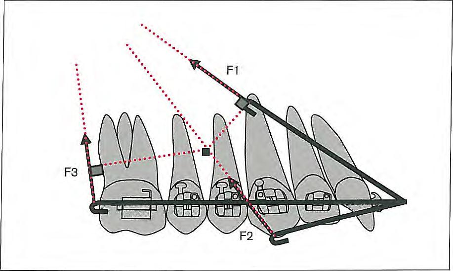 Extraoral Appliances Fig 5-14 The center of resistance in the maxilla is located between the roots of the premolars.