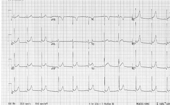 ST Segment Slight elevation with concave morphology in precordial and inferior leads Early repolarization