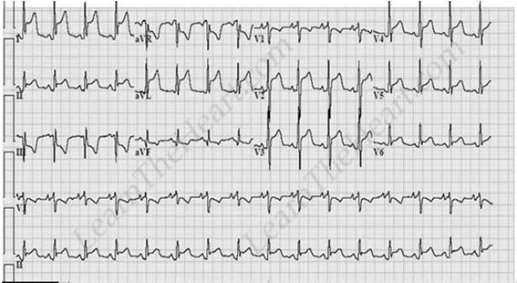 More significant ST elevation and diffuse one with chest pain and URI few weeks before PERICARDITIS QTc Bazett