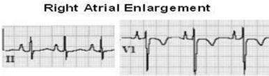 QTc Interval Often miscalculated by EKG machines. >470 msec is likely abnormal regardless of gender or age.
