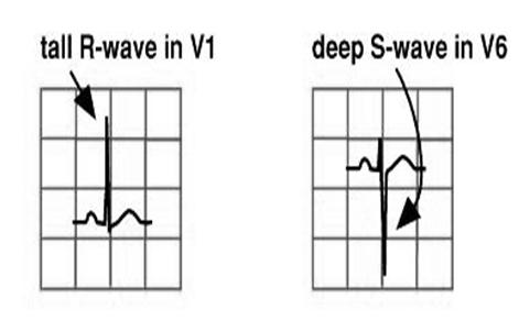 5 mm in lead II Tall P wave = RA enlargement Wide notched P wave = LA enlargement Ventricular Hypertrophy Ventricular