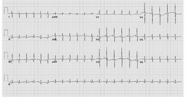 T Wave Abnormalities Peaked Tall T wave = High K. Notched T wave = long QT.