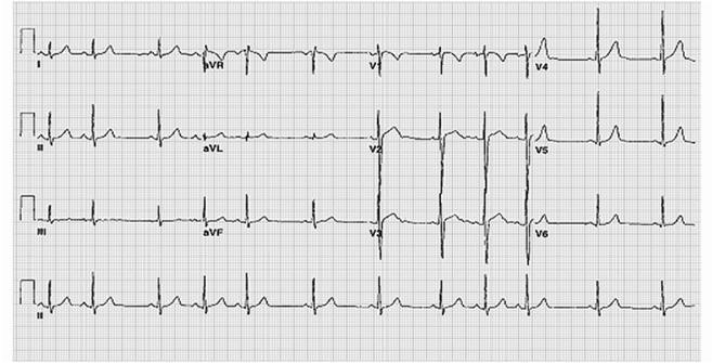 Cases 1 day old girl with Hx of fetal arrhythmia 2 week old with tachycardia 8 year old