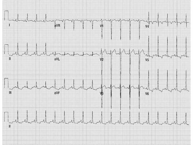 Goes to local ER. Troponin elevated. CXR with cardiomegaly. Transferred to KCH. Echo done and shows.