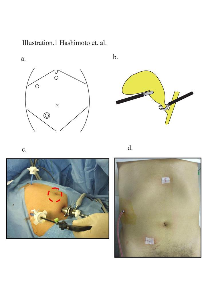 Illustrations Illustration 1 The umbilicus-saving 3-port laparoscopic cholecystectomy.(a) Trocar sites.