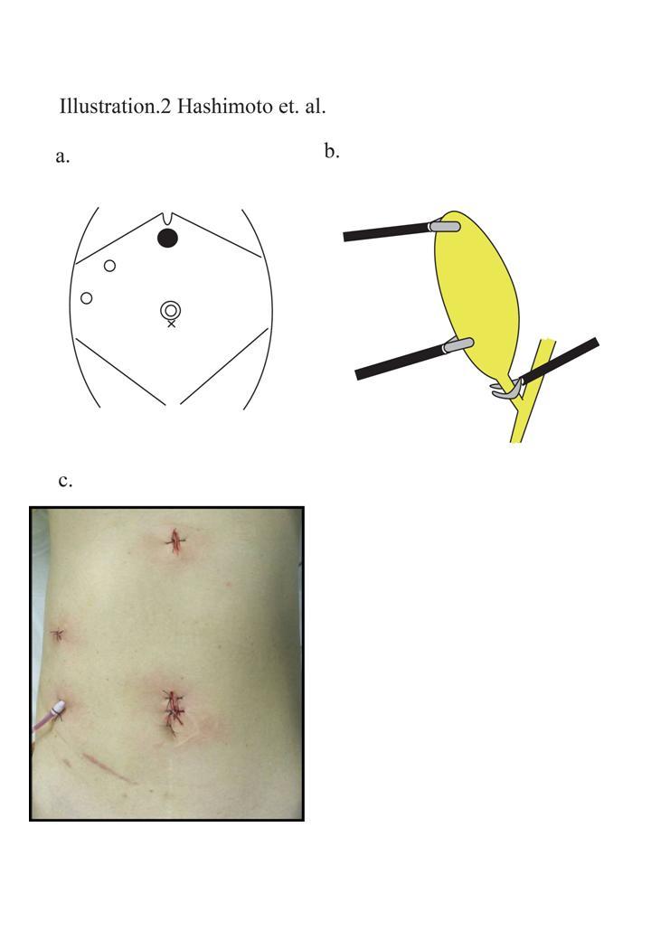 Illustration 2 The standard 4-port laparoscopic cholecystectomy.(a)trocar sites.
