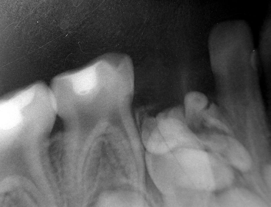 An Unusual Association of Odontomas with Primary Teeth The operation was performed under local anaesthesia. Buccal mucoperiosteal flap was raised in the lower canine region.
