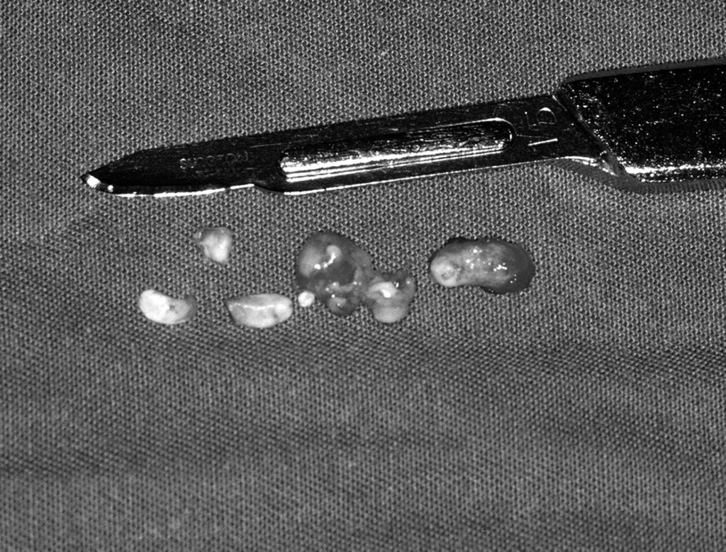 Figure 4. Odontomas after surgical removal. Figure 5. Panoramic radiograph taken two years after the operation. 46 odontoma was made. Post-operative recovery was uneventful.