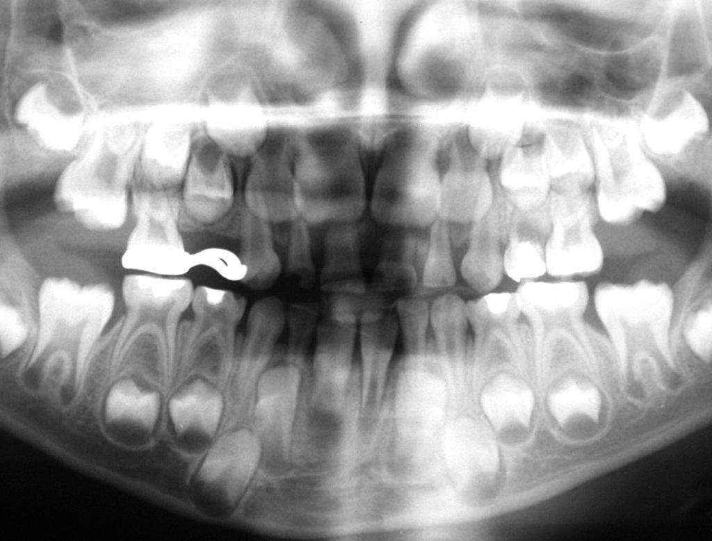 CASE 2: A girl aged 13 years, was referred for management of swelling in the left mandibular primary canine tooth region. Her medical history was clear.