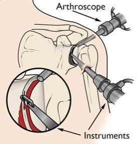 Q: HOW DOES THE SURGEON SEE AND PERFORM WORK IN THE SHOULDER? Surgeons use a small camera (called an arthroscope) and small tools to work inside the shoulder.