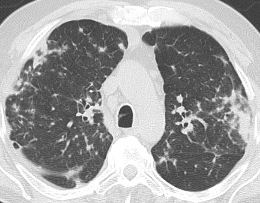 inflammatory syndrom: 60-80 mg/dl Repeated chest CT: