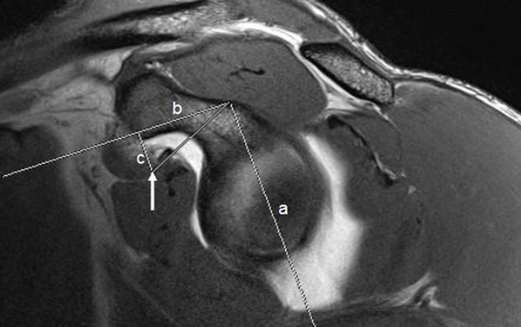 Fig. 2: Sagittal oblique T1 fat saturation image demonstrating measurement of vertical distance of the coracoid tip below the supraglenoid tubercle.