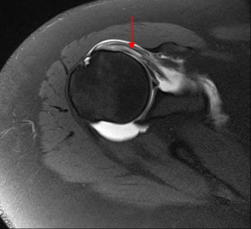 Fig. 4: Subscapularis tendinopathy in a patient with a low lying coracoid tip and reduced subcoracoid space.