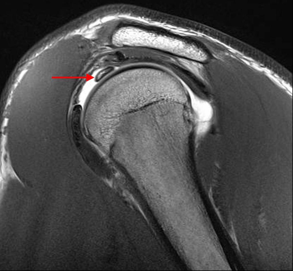 Fig. 5: Long head of biceps tendinopathy (arrow) in a patient with