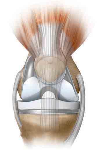 Understanding Knee Replacement The knee is a hingelike joint, formed where the thighbone, shinbone, and kneecap meet. The joint is supported by muscles and ligaments.