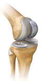 A knee prosthesis (artificial joint) can help restore proper movement.