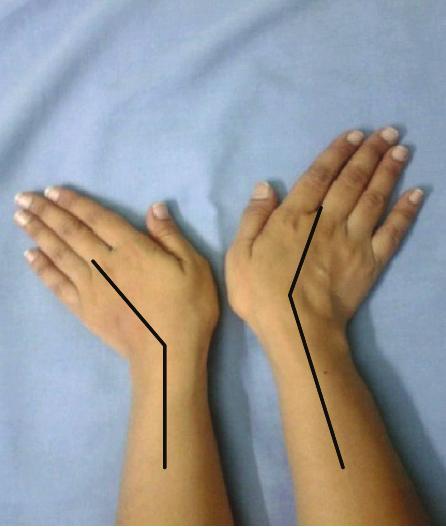 Figure 4: Wrist ulnar deviation