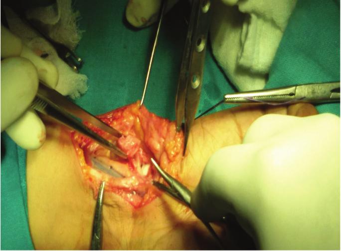 Surgery Steps Figure 11: Incision