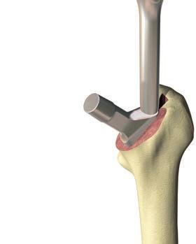 Femoral canal preparation c.