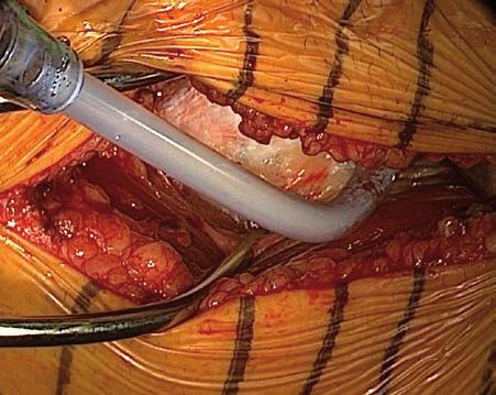 When draping the operative site ensure the surgical field includes the ASIS, a portion of the iliac crest down to the mid-thigh and the greater trochanter. A2.