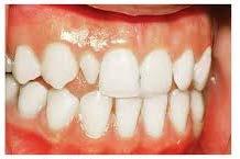 ** Common dental developmental disturbances and involved stage 1. Initiation stage 2.