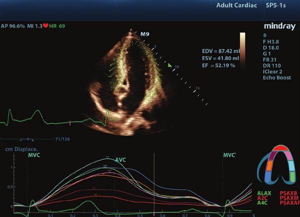 Four chamber view of mitral valve regurgitation Customizable user protocols Flexible wall motion scoring Comprehensive reporting package LVO