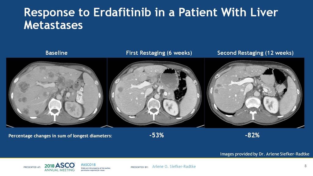 Response to Erdafitinib in a Patient With Liver Metastases