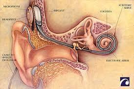 人工耳蝸 (Cochlear