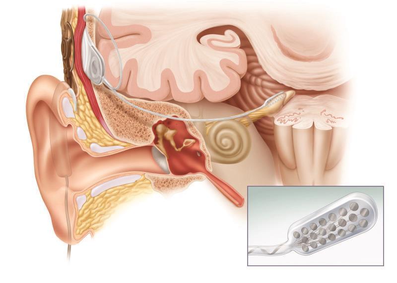 腦幹植入 (Auditory Brainstem Implant)