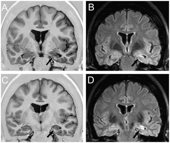 MRI with epilepsy protocol EEG to establish type of