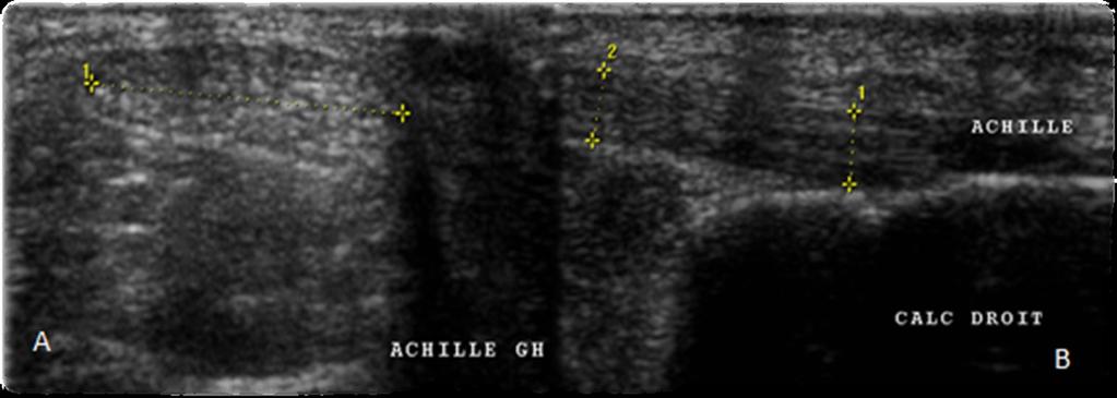 6: Normal Ultrasound appearance of the Achilles