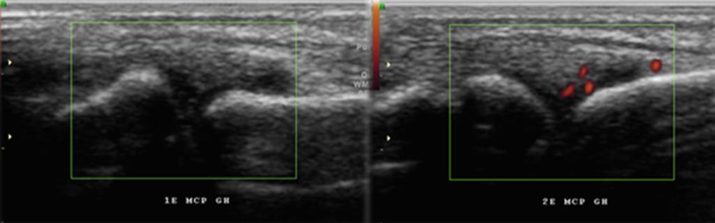 Fig. 18: Longitudinal sonograph demonstred Non active synovitis of the first